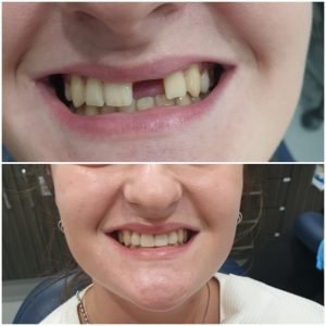 Dental Implants - Tooth Implants Cost Brisbane
