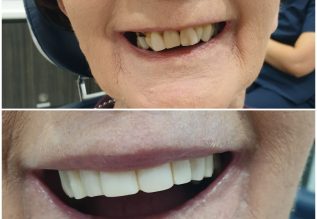 My-gentle-dentist-happy-patient-befor-after-teeth-whitening-6.jpeg Tooth Dentist in Australia