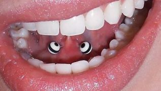 Piercing.jpg Dental Treatment