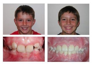 before-after-kids-orthodontics-treatment-1.jpg Orthodontics