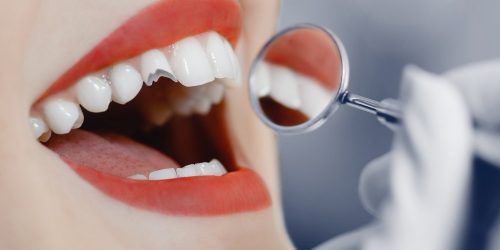 Broken Cracked Tooth – My Gentle Dentist Broken Cracked Tooth - My Gentle Dentist