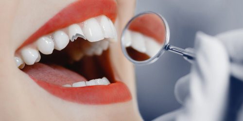 Broken Cracked Tooth – My Gentle Dentist Broken Cracked Tooth - My Gentle Dentist