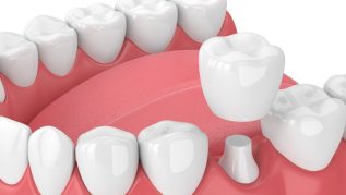 Dental Crown Bridge