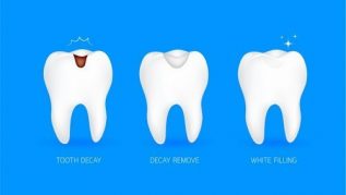 DENTAL FILLINGS DENTAL FILLINGS
