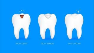 DENTAL FILLINGS