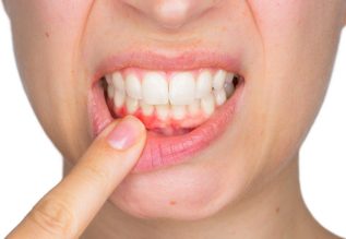 gum-disease-treatment-2.jpg Treatment of Gingivitis