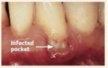 healed-pocket-after-treatment healed-pocket-after-treatment