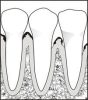Gum Disease Treatment Dentist Gum Disease Treatment Dentist