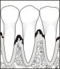 Gum Disease Treatment Dentist Gum Disease Treatment Dentist