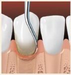 root-planning-smoothes-tooth-root
