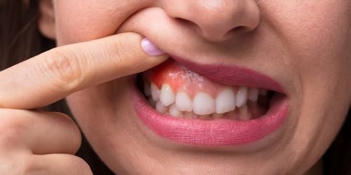 teeth Swelling - My Gentle Dentist