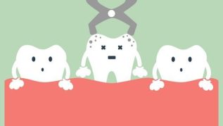 TOOTH EXTRACTION AND REMOVAL COST IN AUSTRALIA TOOTH EXTRACTION AND REMOVAL COST IN AUSTRALIA
