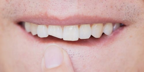 Trauma injury teeth - My Gentle Dentist