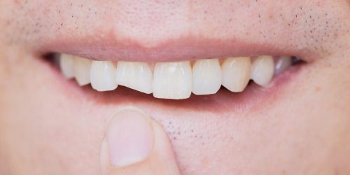 trauma-injury-teeth Trauma injury teeth - My Gentle Dentist