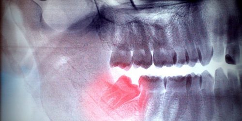 wisdom teeth – My Gentle Dentist wisdom teeth - My Gentle Dentist