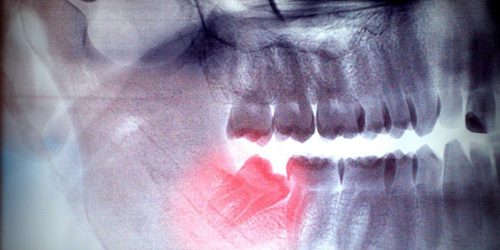 wisdom teeth - My Gentle Dentist