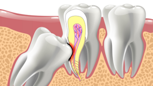 WISDOM TEETH SURGERY COST BRISBANE